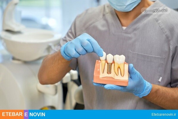 قیمت ایمپلنت دندان در کشورهای مختلف چقدر است؟ 4 ایمپلنت دندان Dental implant