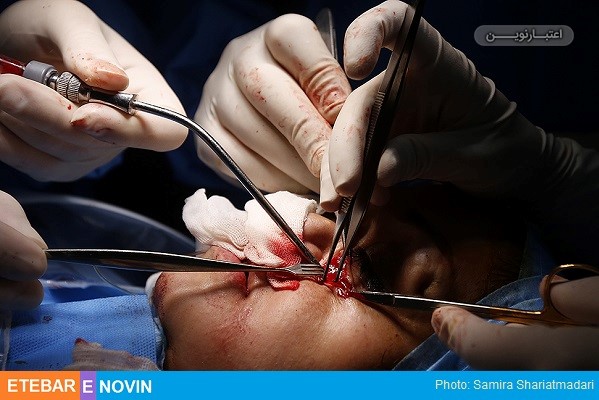 جراحی بینی چگونه انجام میشود؟ 14 جراحی زیبایی
